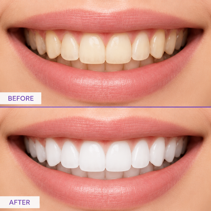 Teeth Whitening Strips